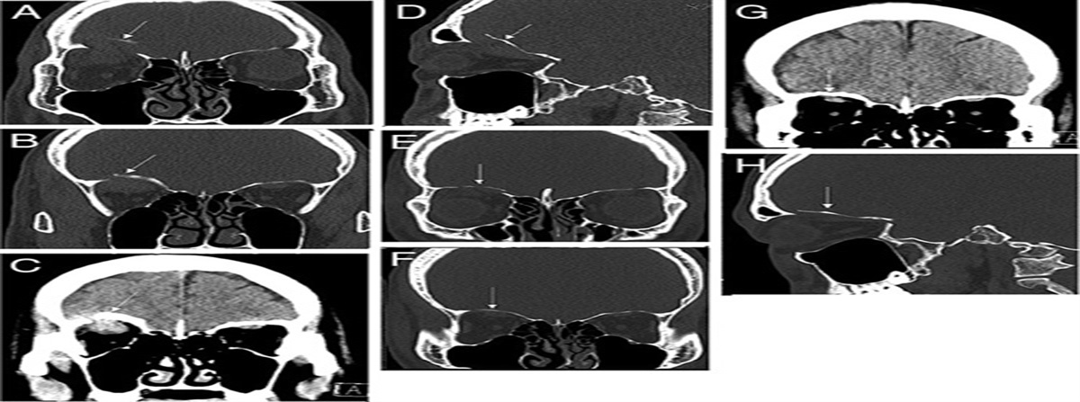 Spontaneous Repositioning of Significant Blow-out Orbital Roof Fracture Associated With Intracranial Hematoma