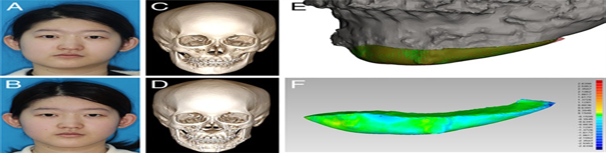 Himi-Lengthening Genioplasty: A Modified Technique for the Correction of Mandibular Asymmetry