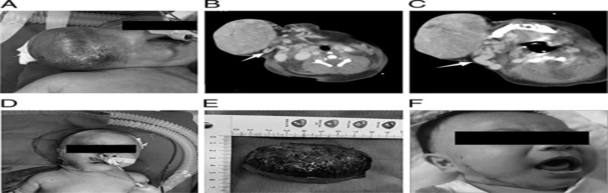 Multidisciplinary Treatment of a Giant Maxillofacial Congenital Hemangioma With Multiple Severe Complications