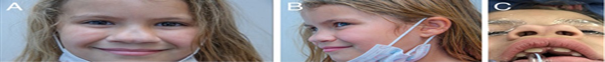 Nasal Bifidity: An Unusual Pediatric Congenital Anomaly and Review of the Literature