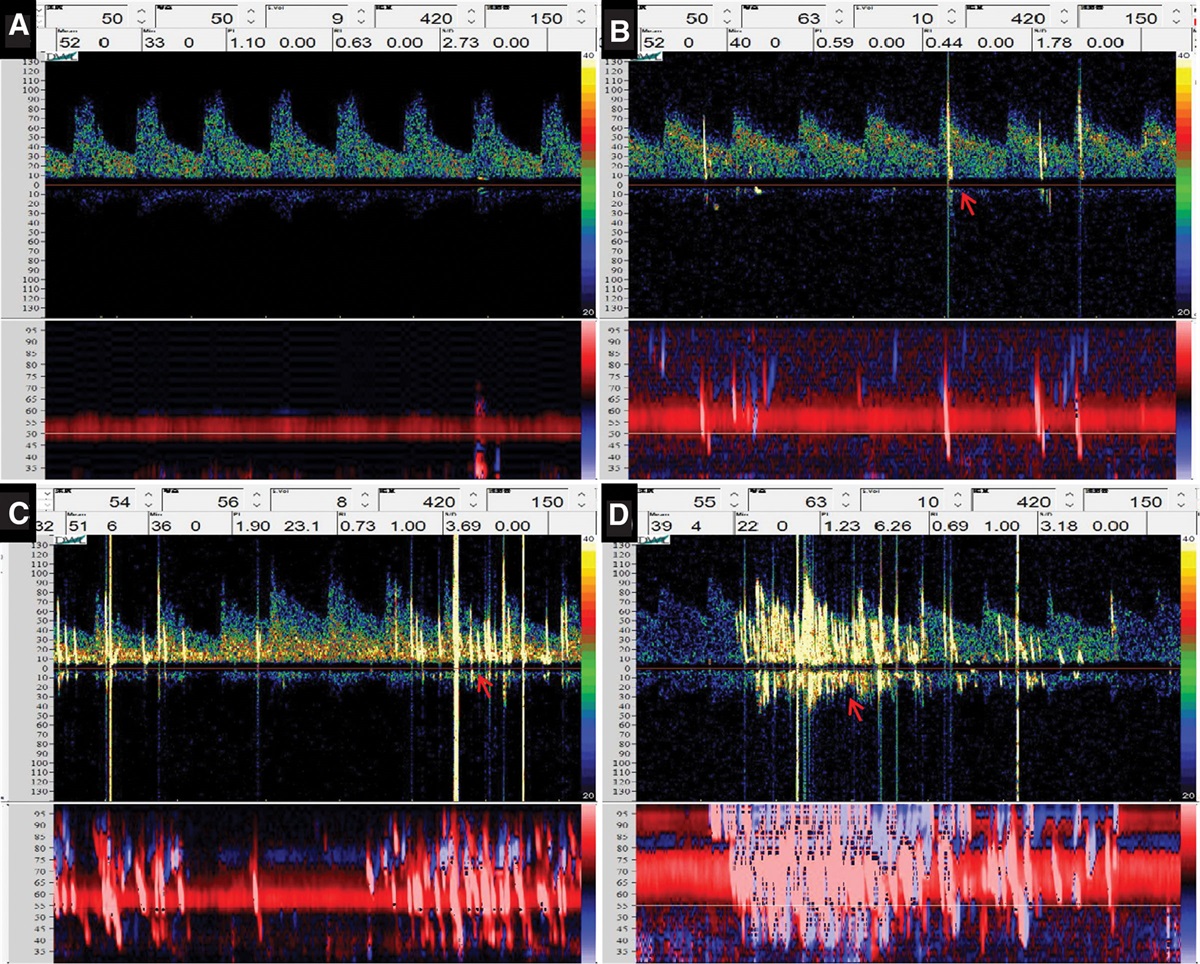 Detection rate and shunt grading with synchronous testing of contrast transcranial Doppler and contrast transthoracic echocardiography: Preliminary findings