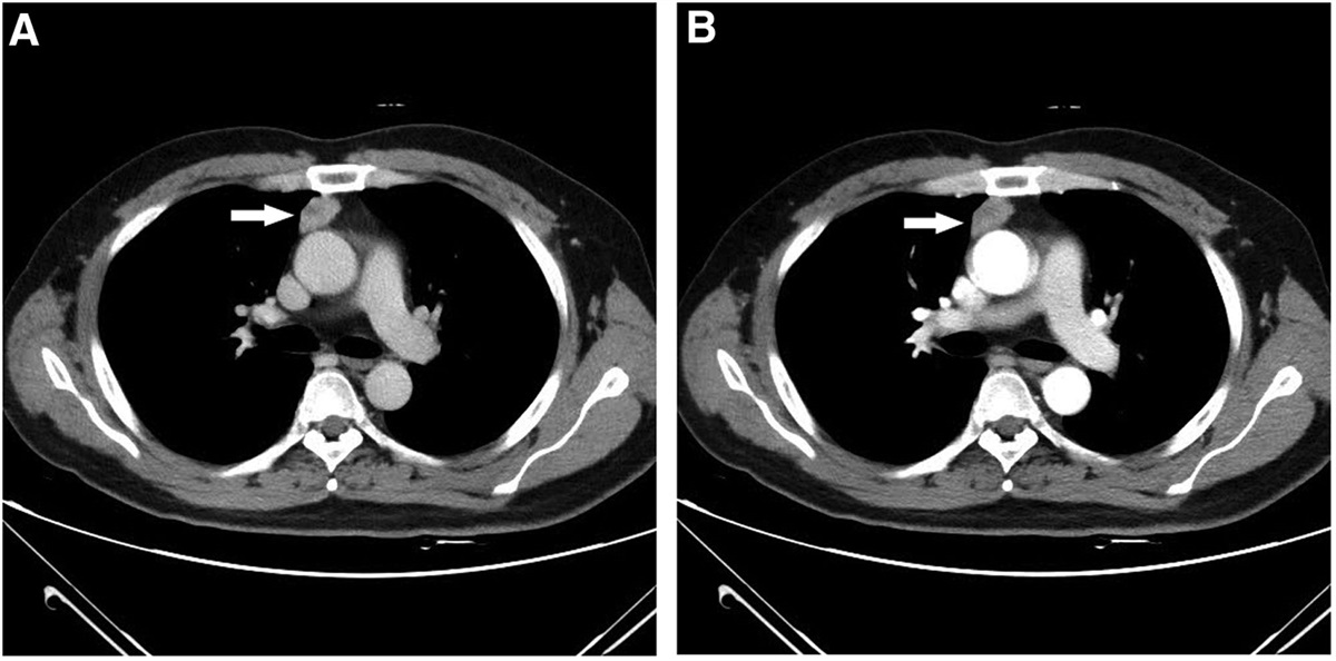 Atypical thymic carcinoid tumor with ectopic ACTH syndrome in a 33-year-old male patient: A rare case report and literature review