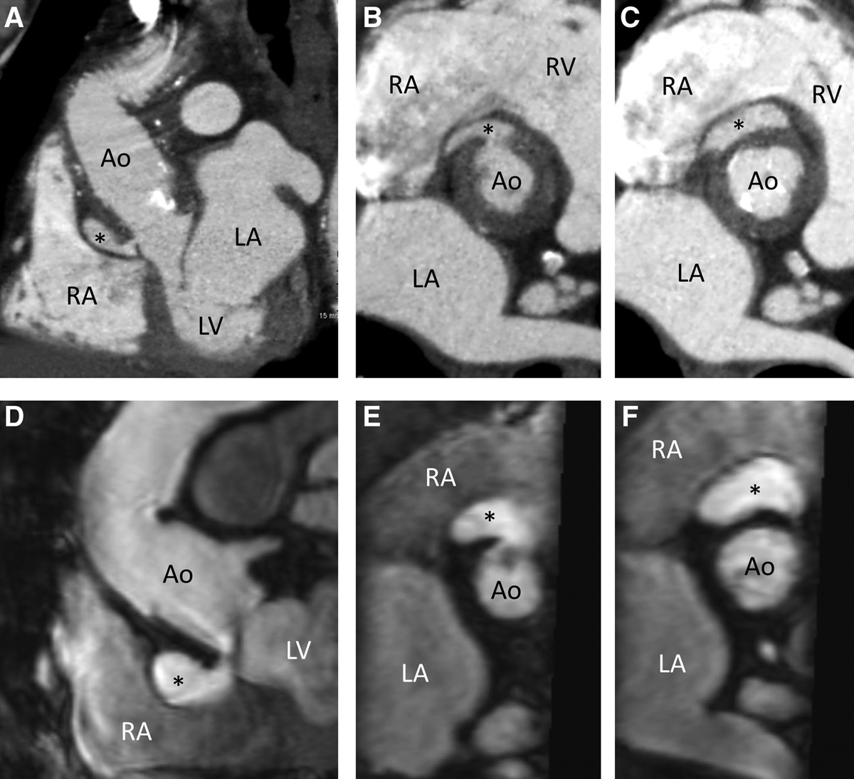 ECG-gated MR angiography at 3T for follow-up after surgery involving the ascending aorta
