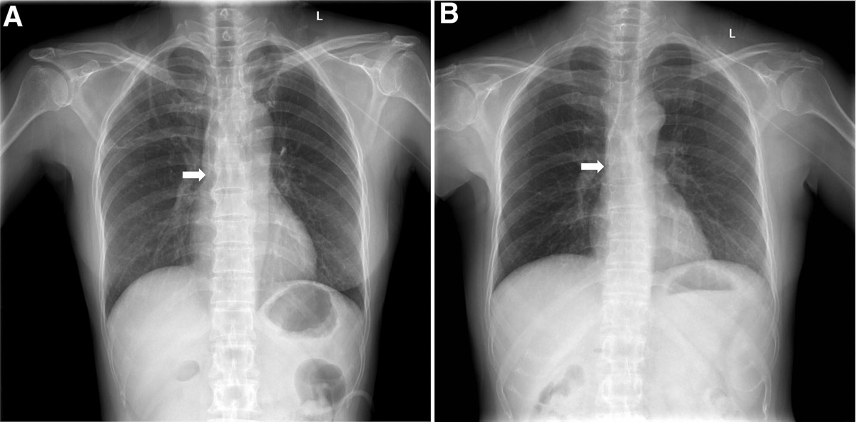 Spontaneous migration of peripherally inserted central catheter into the azygos vein during postoperative gastrointestinal dysmotility: A case report
