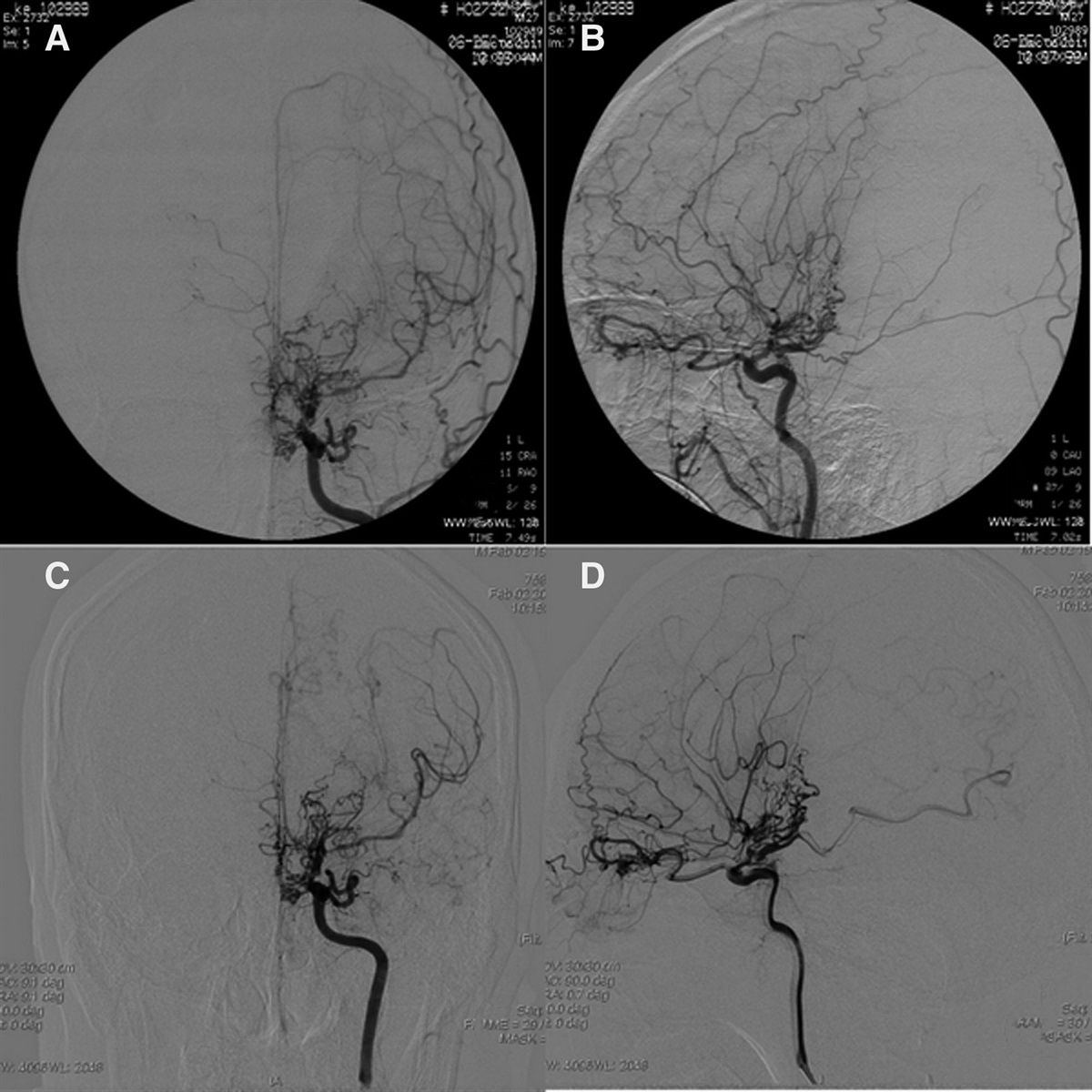 Moyamoya disease with distal anterior choroidal artery aneurysm resected via transcallosal approach: A case report and review