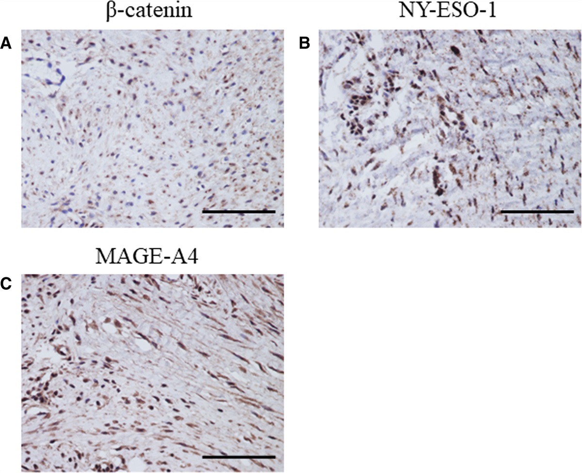 Involvement of NY-ESO-1 and MAGE-A4 in the pathogenesis of desmoid tumors