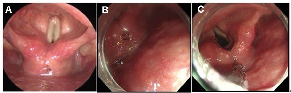 Case report of laryngeal infection by Clinostomum complanatum 24 days after ingestion of raw fish