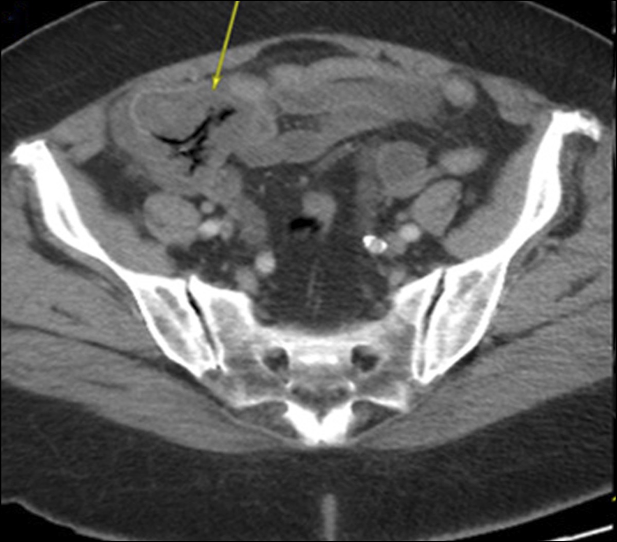 Isolated Cecal Necrosis Mimicking a Colonic Mass