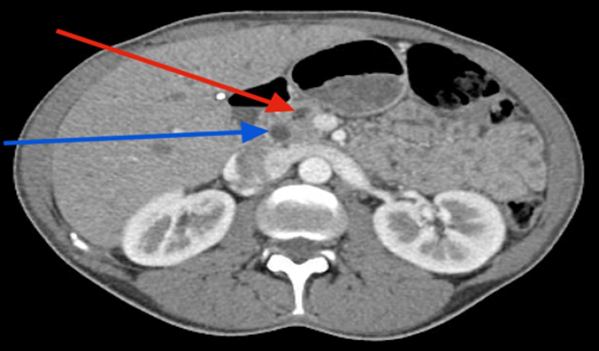Splenic Subcapsular Hematoma After Endoscopic Retrograde Cholangiopancreatography