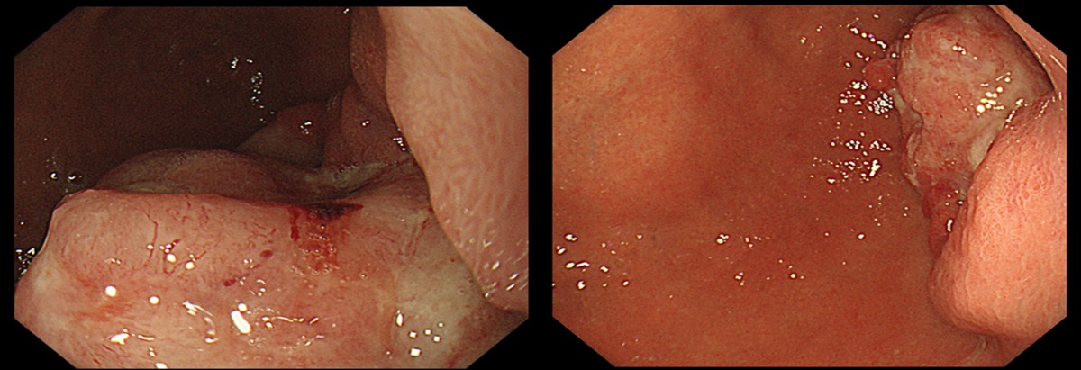 Gastric Carcinoma With Sebaceous Differentiation and SALL4 Expression