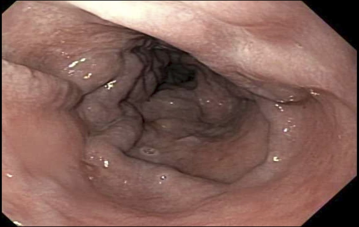 Successful Treatment of Achalasia With Endoscopic Ultrasound–Guided Botulinum Injection in Setting of Esophageal Varices