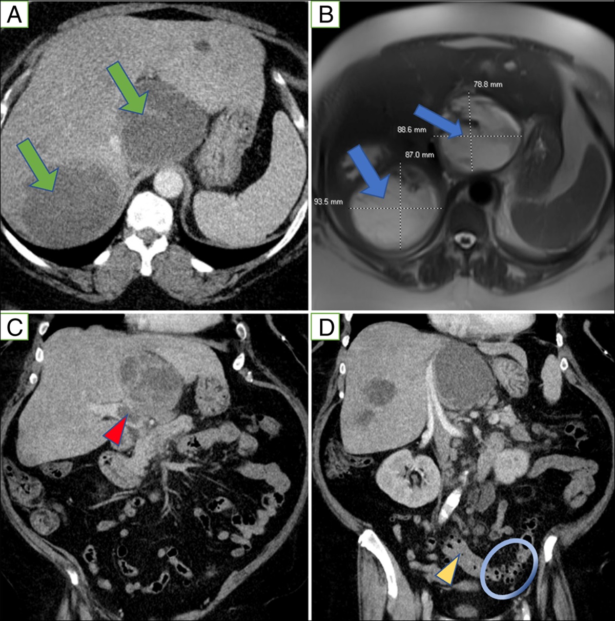 Pylephlebitis Complicated by Hepatic Abscesses due to Fusobacterium Nucleatum: A Case of Lemierre's Syndrome Variant and Literature Review