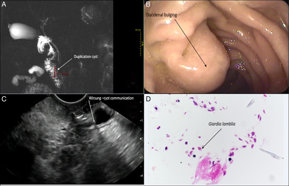 Giardia lamblia Infection in a Duodenal Duplication Cyst as a Potential Cause of Recurrent Acute Pancreatitis