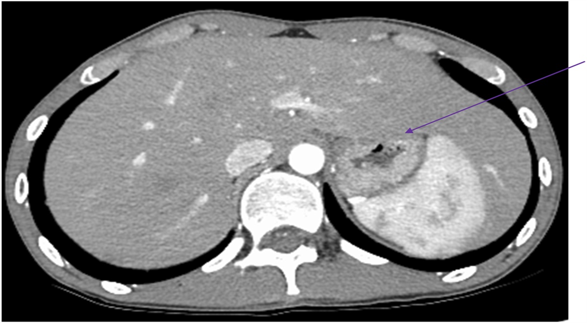 Multiple Acyl-CoA Dehydrogenase Deficiency: A Rare Cause of Hepatomegaly