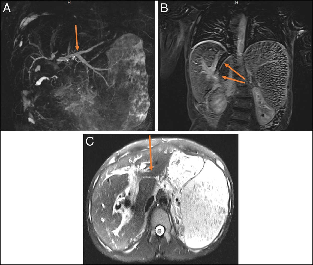 Bad Connection: Stent-to-Stent Fistulization After Common Bile Duct and Transjugular Intrahepatic Portosystemic Shunt Stenting