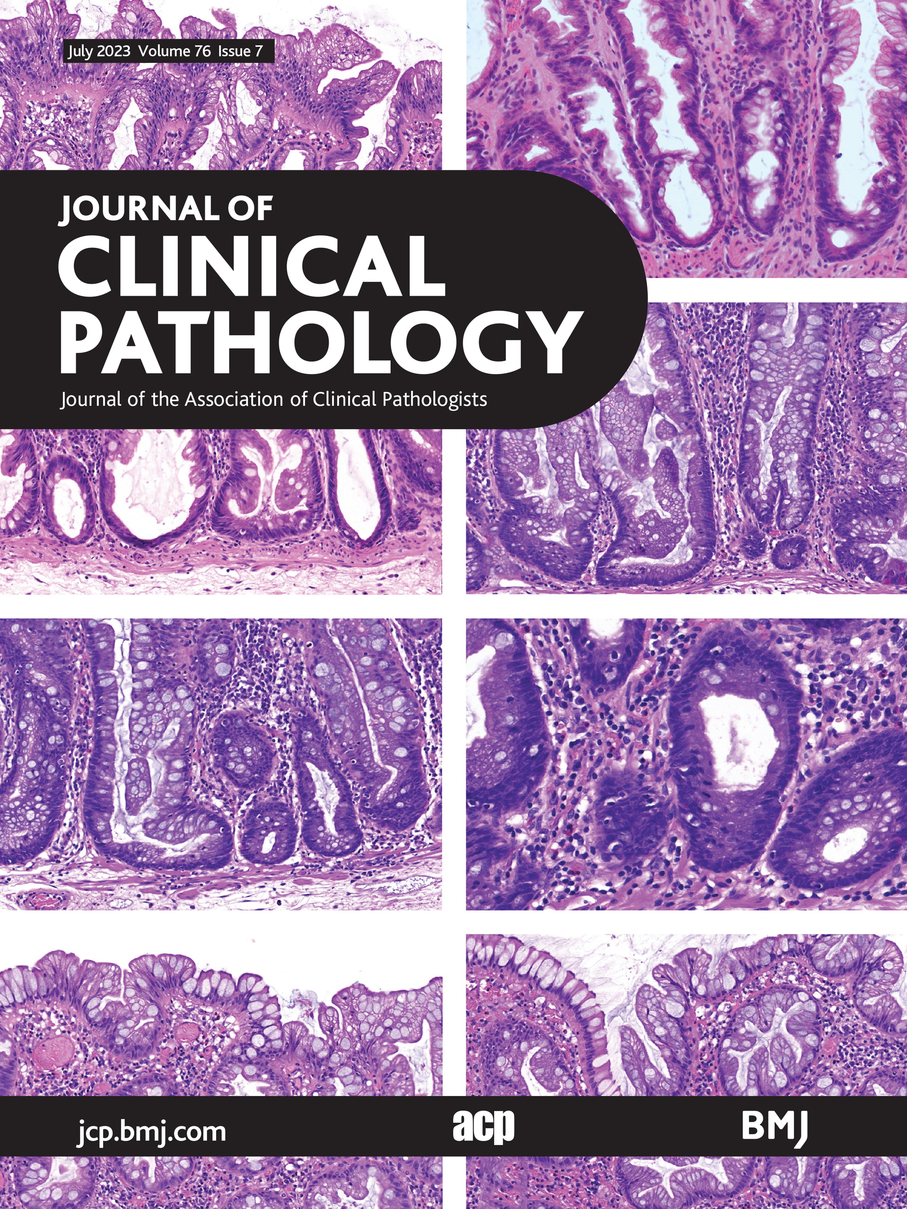 Performance and pitfalls of the tools for measuring glomerular filtration rate to guide chronic kidney disease diagnosis and assessment