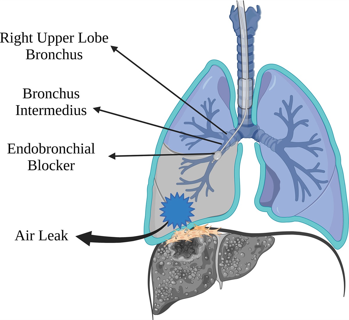 Pulmonary Injury Causing a Massive Air Leak During Liver Transplantation: A Case Report and Discussion of Decision-Making