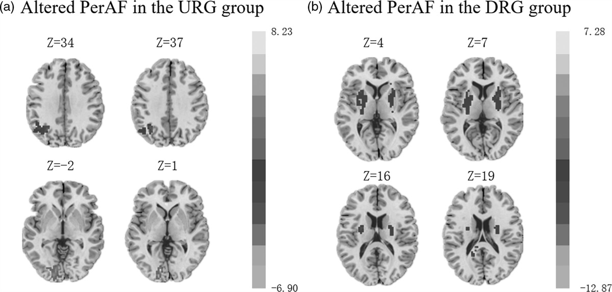 Altered amygdala functional connectivity after real-time functional MRI emotion self-regulation training