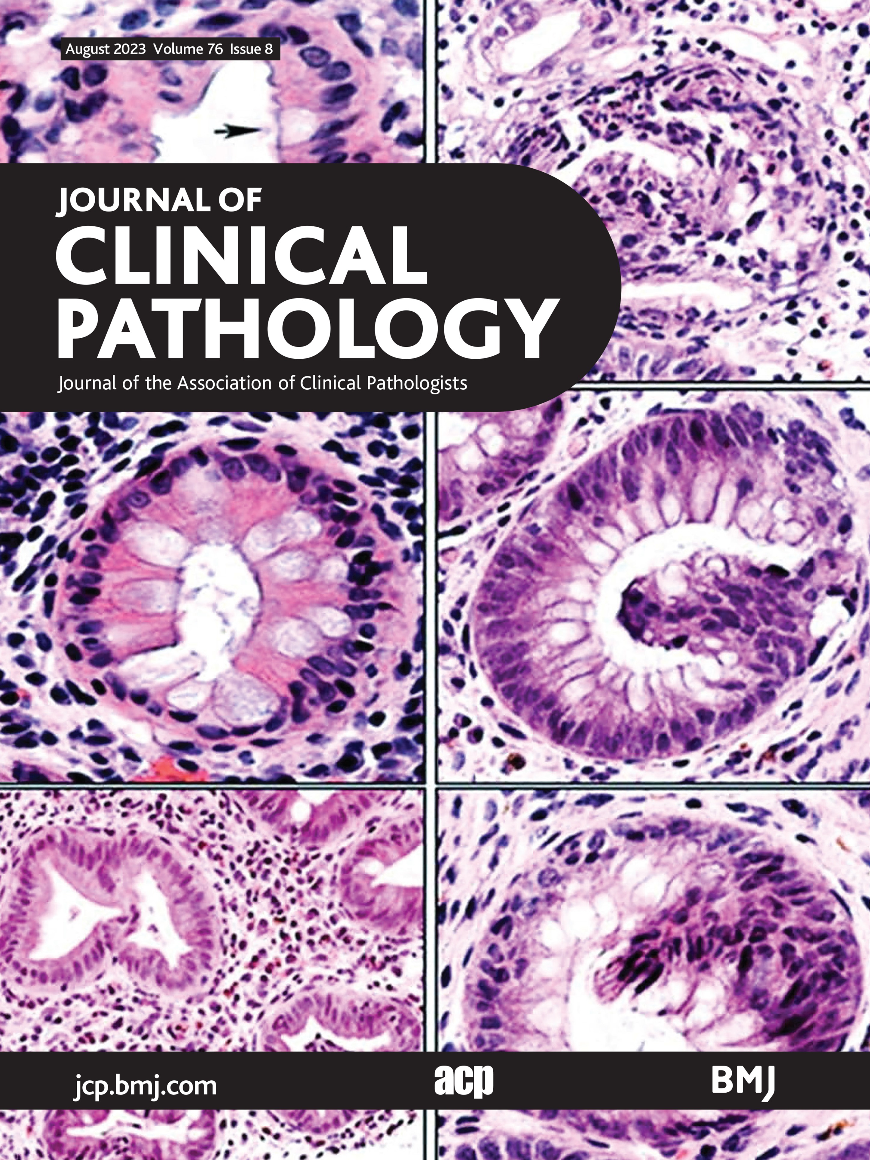 Novel histological repertoire of crypt-associated anomalies in inflamed colon mucosa
