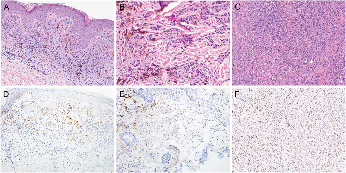 PRAME and LEF1 in Combined Deep Penetrating Nevus and Combined Blue Nevus: Utility and Pitfalls