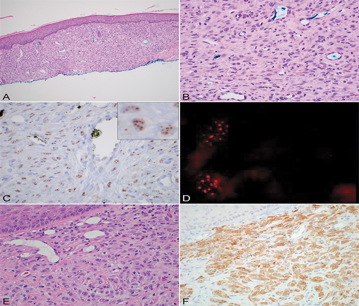 A Novel Fusion Partner, SP100, Drives Nuclear Dot Localization of ALK in Epithelioid Fibrous Histiocytoma