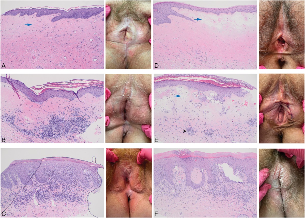 Vulvar Lichen Sclerosus Clinical Severity Scales and Histopathologic Correlation: A Case Series