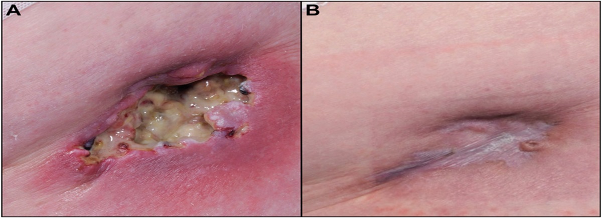 Skin-Limited, Methotrexate-Associated Epstein–Barr Virus–Positive Mucocutaneous Ulcer—A Mimicker of High-Grade Lymphoma. A Report of 4 Cases and Review of the Literature