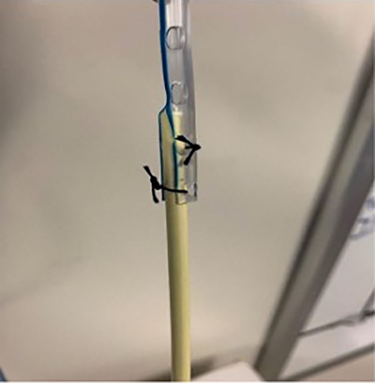 Oral to Nasal Endotracheal Tube Exchange: Modification to Enable Wider Applicability of an “Old Connector” Technique—A Case Report