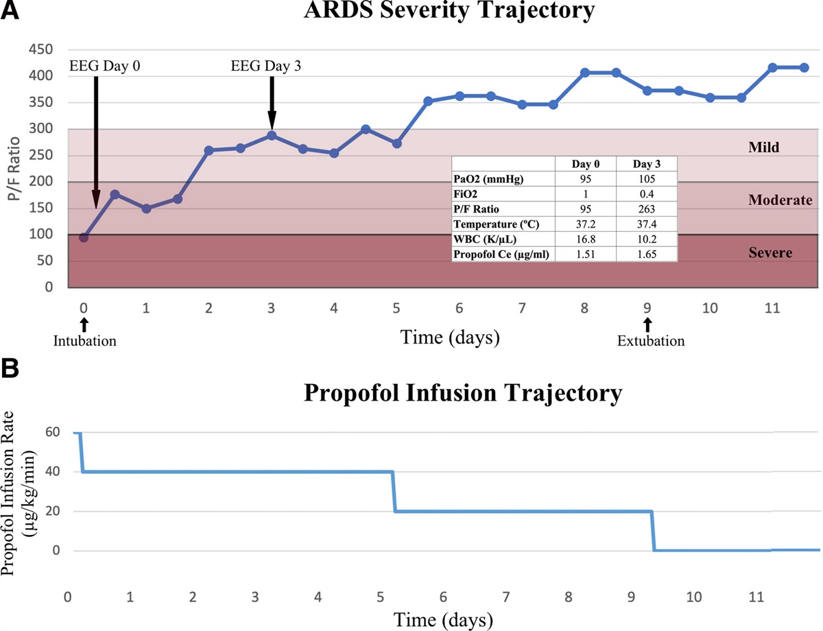 Recovery From Acute Respiratory Distress Syndrome Is Associated With Increasing Alpha Power in the Frontal Electroencephalogram During Propofol Sedation: A Case Report