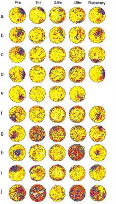 Interpreting the meaning of changes in hippocampal volume associated with vestibular loss