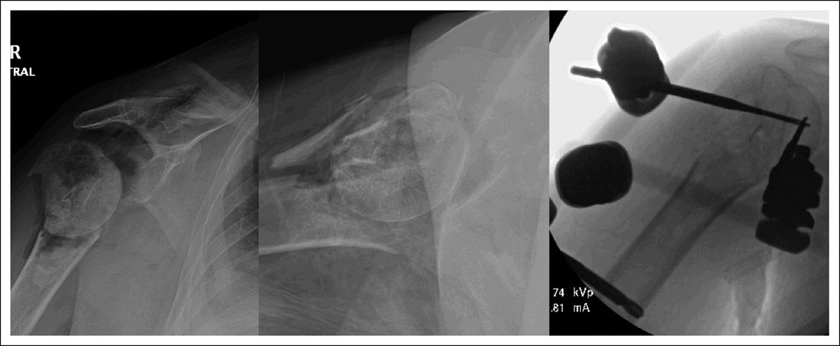 The Role of External Fixation in the Management of Upper Extremity Fractures