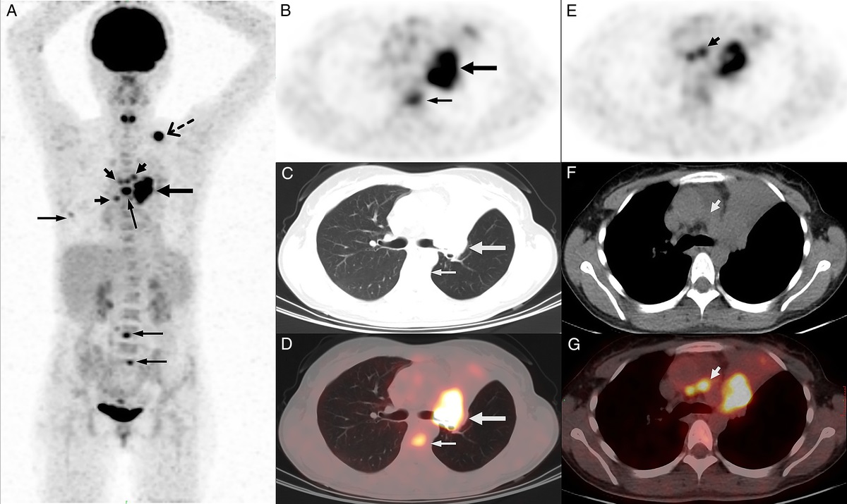 Metastatic Pulmonary Desmoplastic Small Round Cell Tumor on FDG PET/CT
