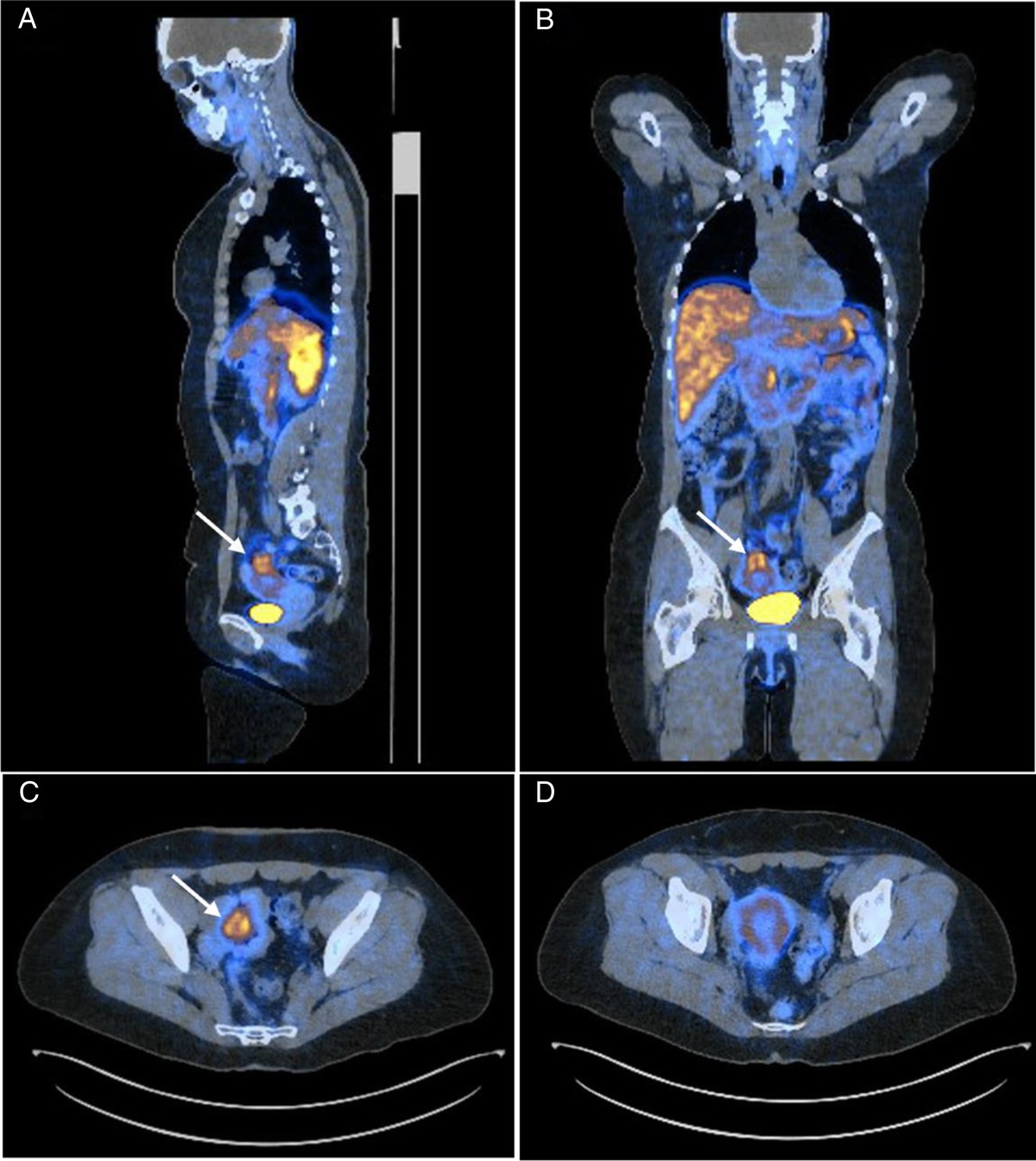 False-Positive 68Ga-DOTATATE Uptake in a Uterine Subserosal Fibroid Mimicking Mesenteric Neuroendocrine Tumor: A Case Study