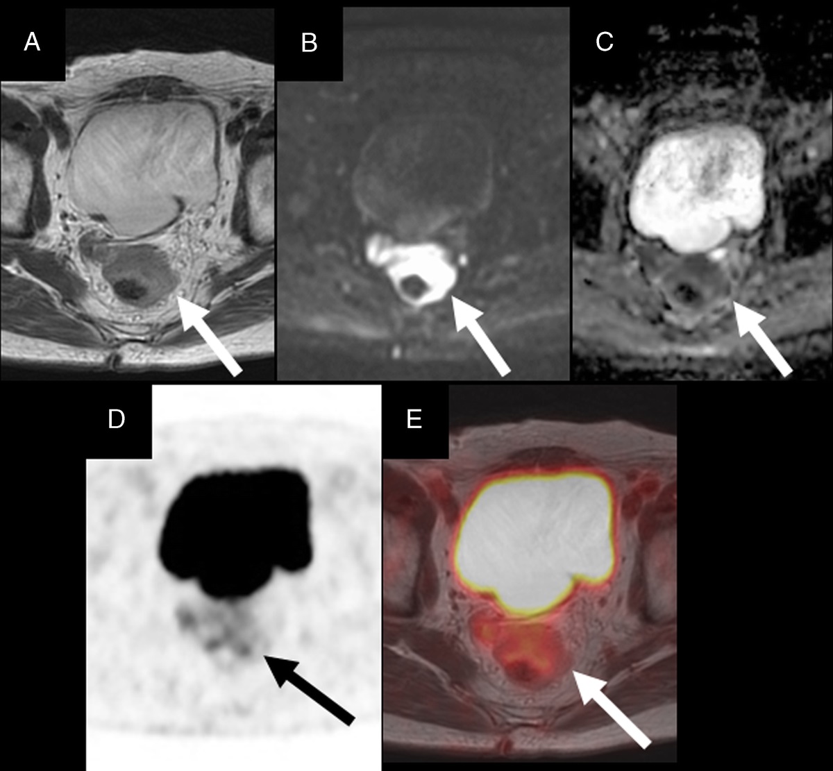 A Case of Rectal Dissemination of Gastric Cancer Diagnosed by Simultaneous 18F-FDG PET/MRI