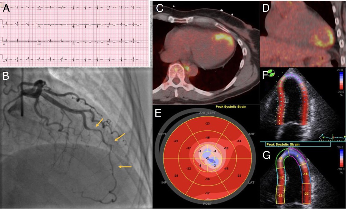Novel Diagnostic Imaging Approach for Patients With Spontaneous Coronary Artery Dissection: The Utility of: 18: F-FDG PET Imaging