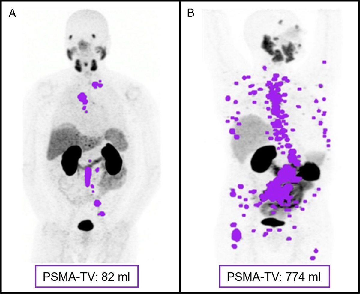 Tumor Volume on PSMA PET as a Prognostic Biomarker in Prostate Cancer Patients Treated With Cabazitaxel