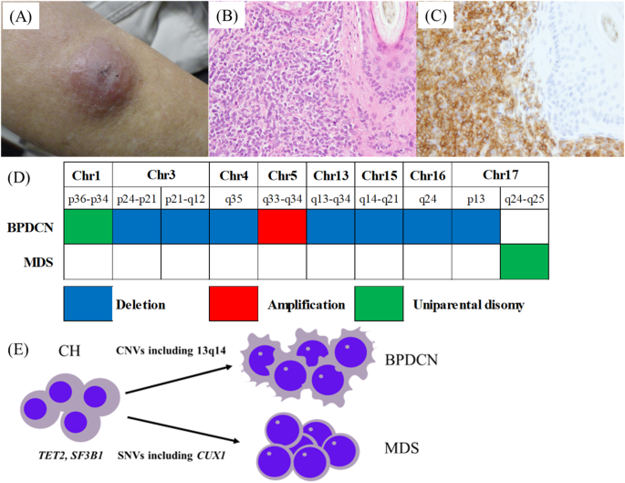 Coincidence of cutaneous blastic plasmacytoid dendritic cell neoplasm and myelodysplastic syndrome derived from clonal hematopoiesis
