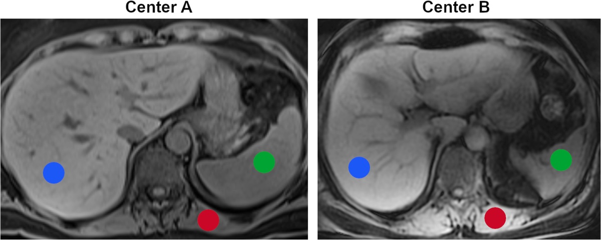 ComBat Harmonization for MRI Radiomics: Impact on Nonbinary Tissue Classification by Machine Learning