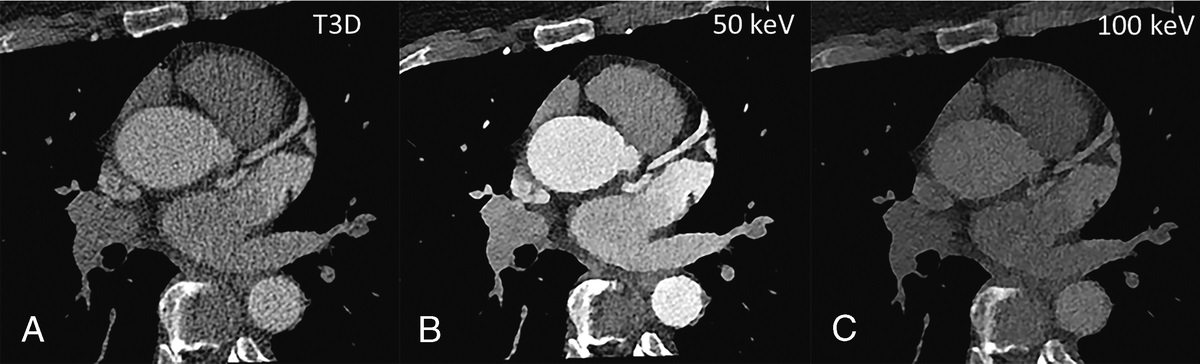High-Pitch Multienergy Coronary CT Angiography in Dual-Source Photon-Counting Detector CT Scanner at Low Iodinated Contrast Dose
