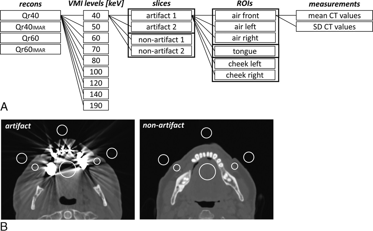 Artifact Reduction From Dental Material in Photon-Counting Detector Computed Tomography Data Sets Based on High-keV Monoenergetic Imaging and Iterative Metal Artifact Reduction Reconstructions—Can We Combine the Best of Two Worlds?