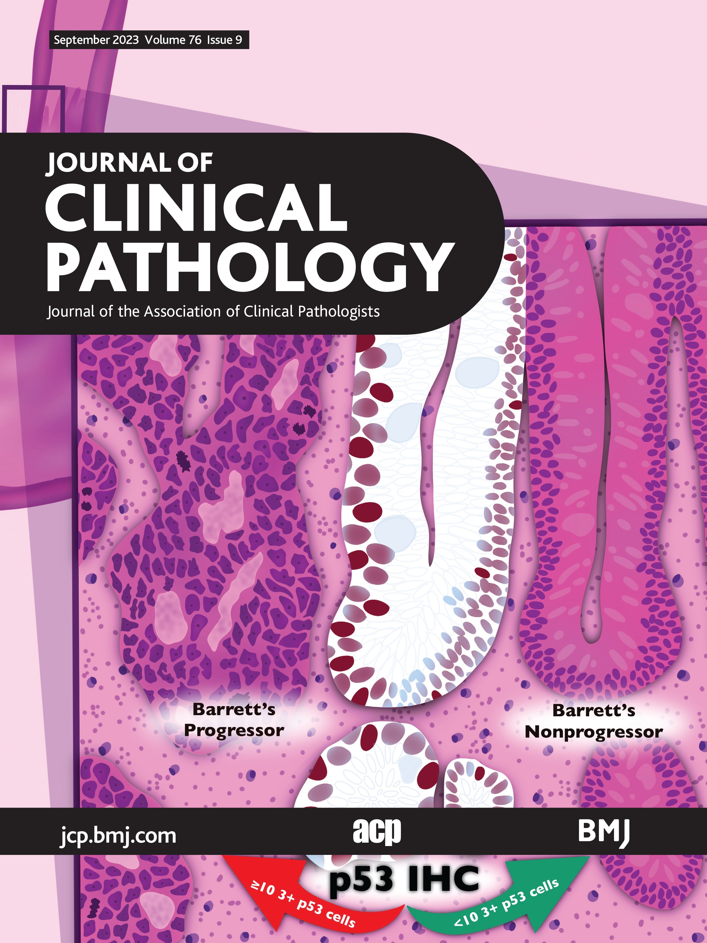 Beyond the routine CBC: machine learning and statistical analyses identify research CBC parameter associations with myelodysplastic syndromes and specific underlying pathogenic variants