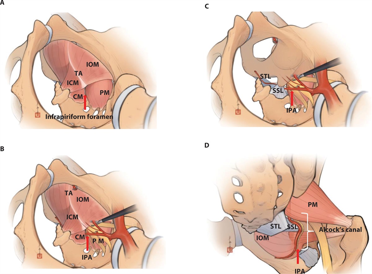 Transanal Minimally Invasive Surgical Approach to Total Pelvic Exenteration