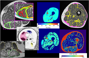 Magnetic resonance imaging techniques for the quantitative analysis of skeletal muscle: State of the art