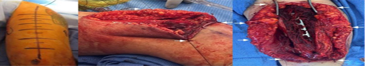 Lose the Big Retractors: Retraction Sutures for Upper Extremity Surgery