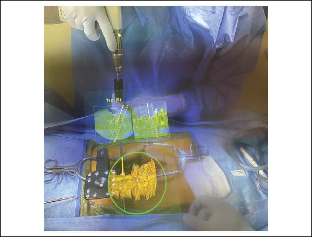 Applications of Augmented Reality in Orthopaedic Spine Surgery