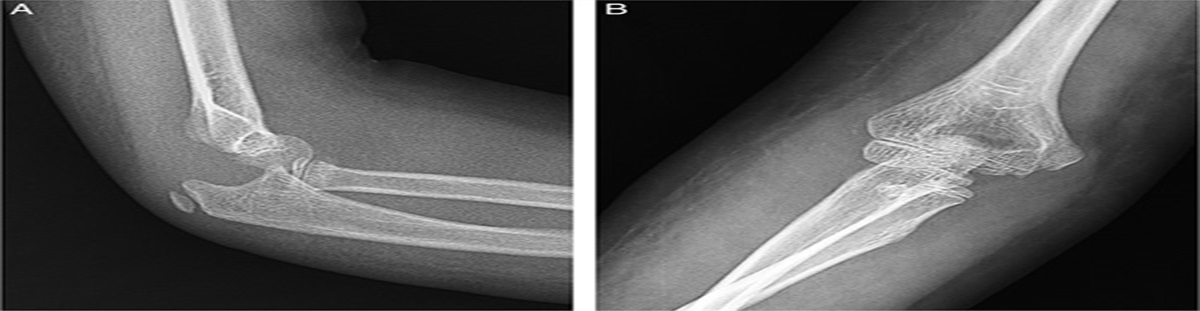 New variant of terrible triad injury in a pediatric patient: a case report