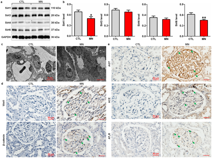 Sirtuin 6 protects against podocyte injury by blocking the renin-angiotensin system by inhibiting the Wnt1/β-catenin pathway