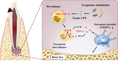 Ferroptosis of macrophages facilitates bone loss in apical periodontitis via NRF2/FSP1/ROS pathway