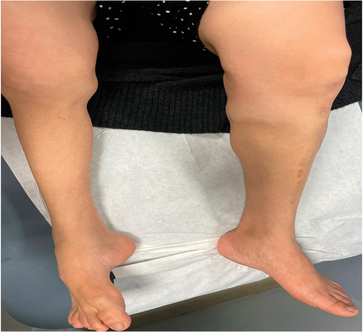 Extensive Progressive Atrophy of Lower Extremities in an Adult Woman: Challenge