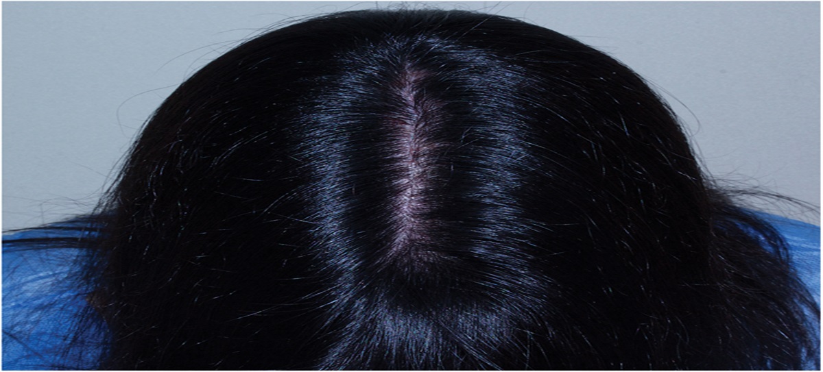 Persistent Erythematous Papules on Inflammatory Scalp: Challenge